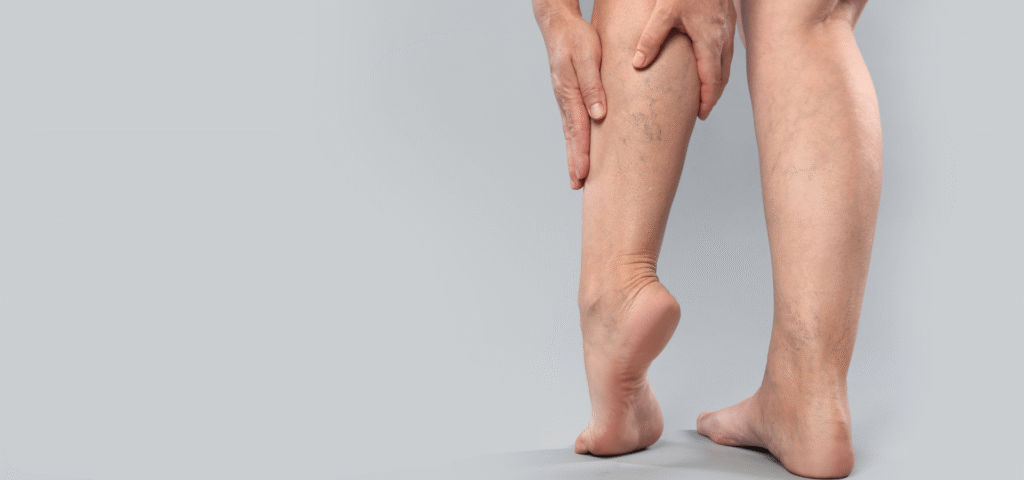 Flebologia Trap Napoli