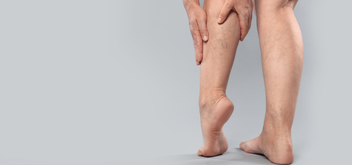 Flebologia Trap Napoli