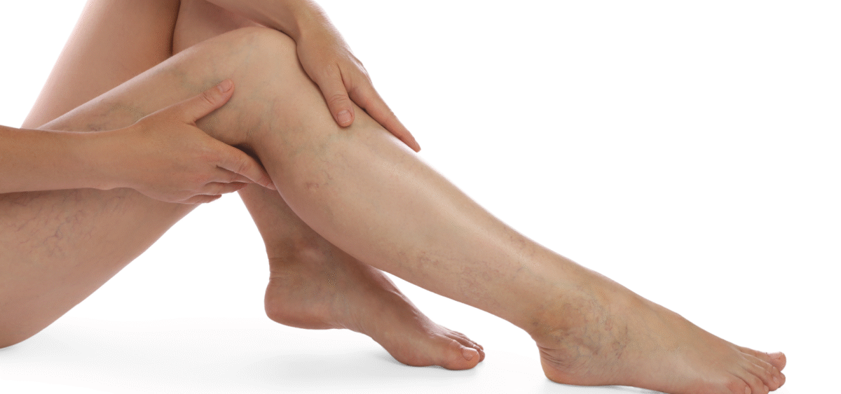 Flebologia Trap Caserta